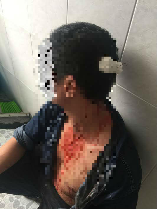 Anh T. bị hành hung phải nhập viên điều trị tại BV Nhân dân 115.