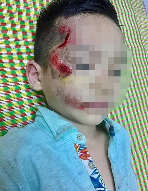 Cháu bé bị thương tích trên mặt (Nguồn Infornet).