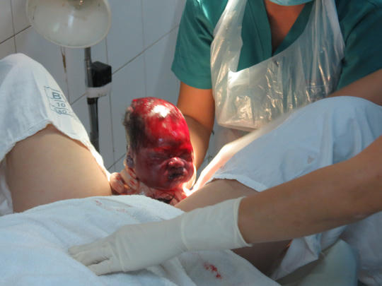 Khoảnh khắc cháu bé được đưa ra khỏi bụng mẹ
