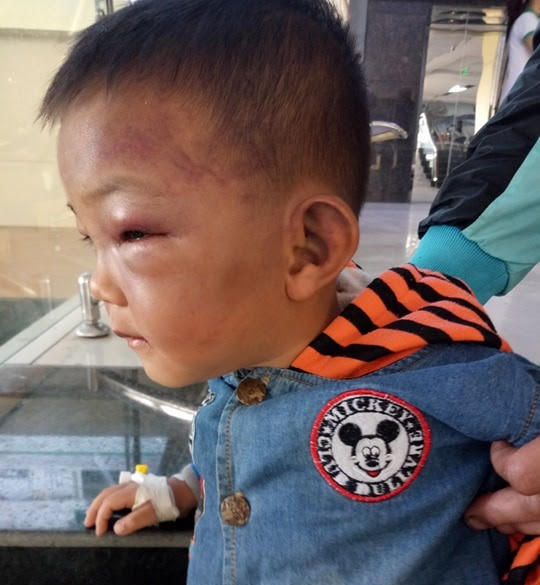 Ch&aacute;u Hiếu nhập viện trong t&igrave;nh trạng mặt m&agrave;y sưng ph&ugrave;.