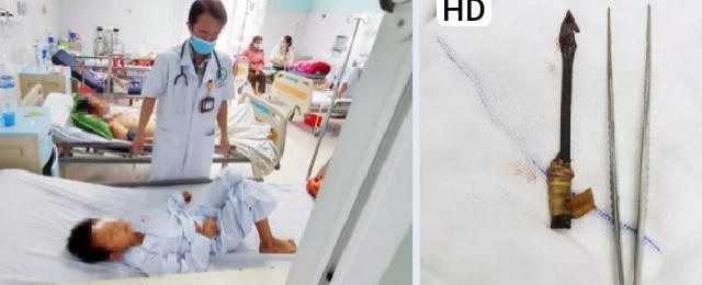 Cứu sống cháu bé bị mũi tên đâm xuyên mắt gần vào sọ não