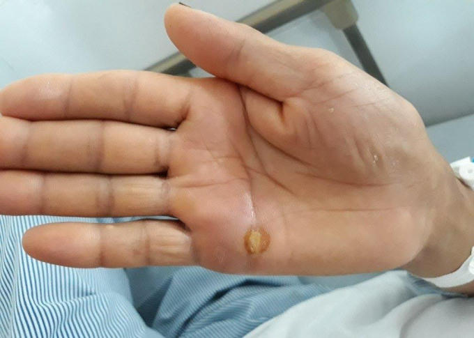 Khoảng 10 ngày trước khi nhập viện, bệnh nhân bị dằm tre đâm vào tay. (Ảnh: BVCC)