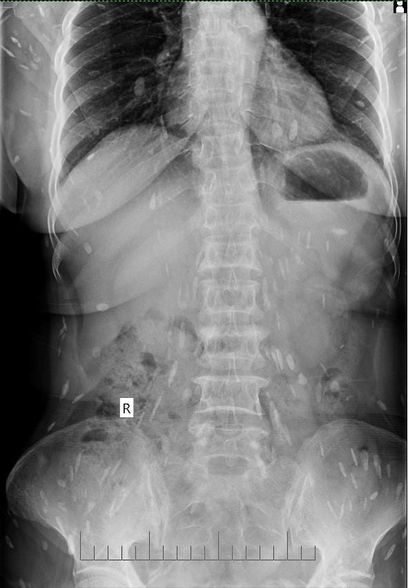 Hình ảnh cho thấy bà Đ bị sán lá gan nhiều.