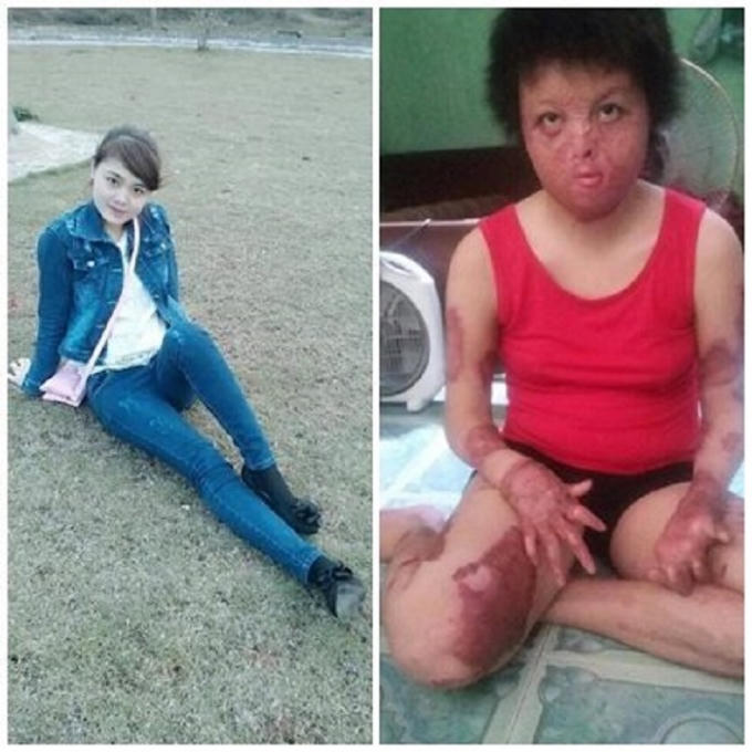 Hình ảnh người vợ 9x trước và sau khi bị chồng tẩm xăng đốt. (Nguồn: Facebook).