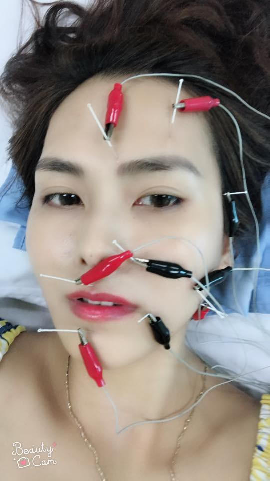 Cô phải thường xuyên đi châm cứu, bấm huyệt và tiêm.
