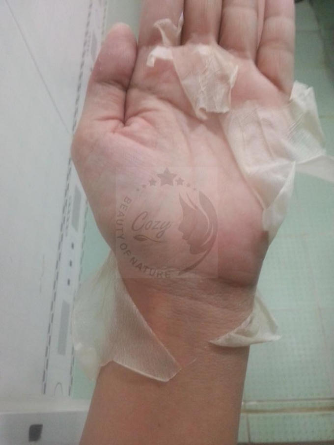 Da bàn tay dày, nhưng khi dùng loại kem trộn này có thể bong tróc như bị bỏng.