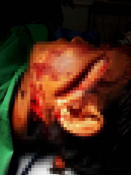 Nhiều vết thương trên vùng mặt, cổ  chị Moong Mẹ Minh