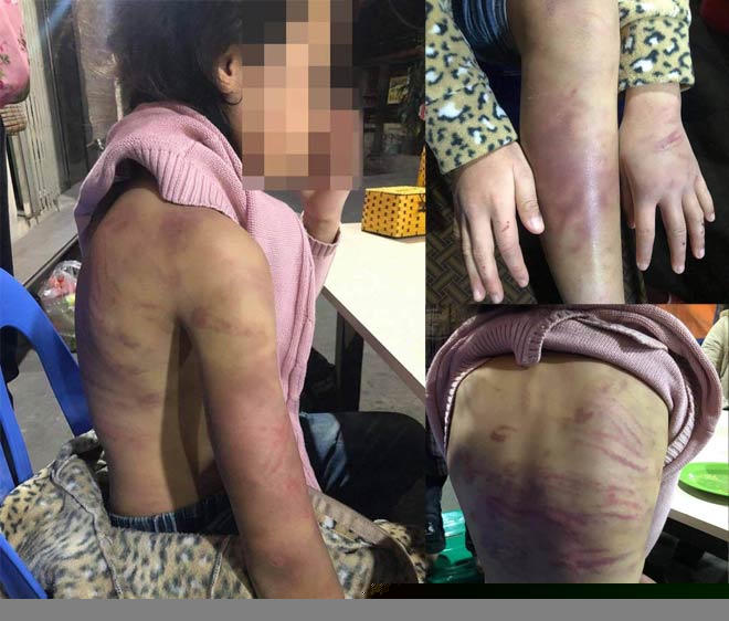N.H.B bị mẹ bạo hành bầm tím người.