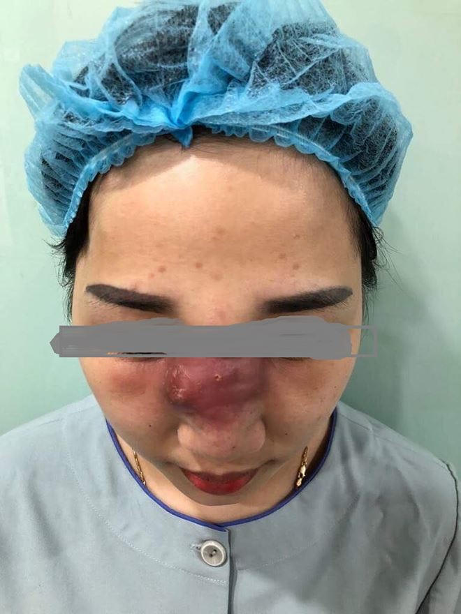 Mũi của nữ bệnh nhân có dấu hiệu mưng mủ, hoại tử