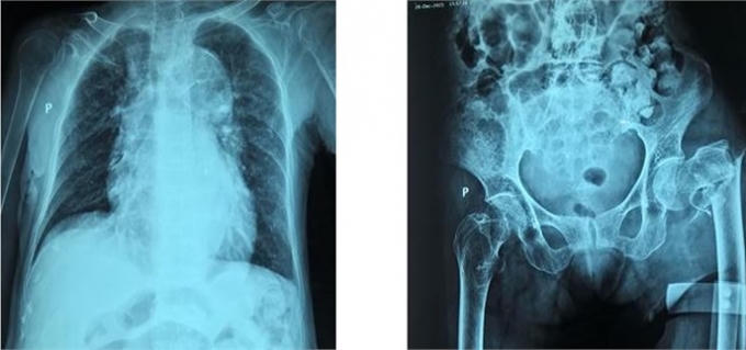 Bà cụ 102 tuổi được phẫu thuật nối xương đùi