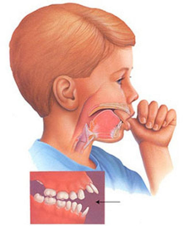 Ngậm mút tay gây nhiều bất lợi cho sức khỏe và sự phát triển của trẻ.