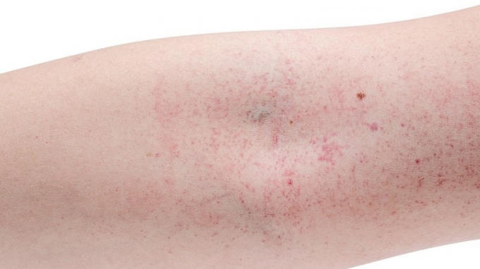 Theo báo cáo của Sở Y tế Hà Nội, tính từ đầu năm 2020 đến nay, thành phố ghi nhận 1.574 trường hợp mắc sốt xuất huyết.