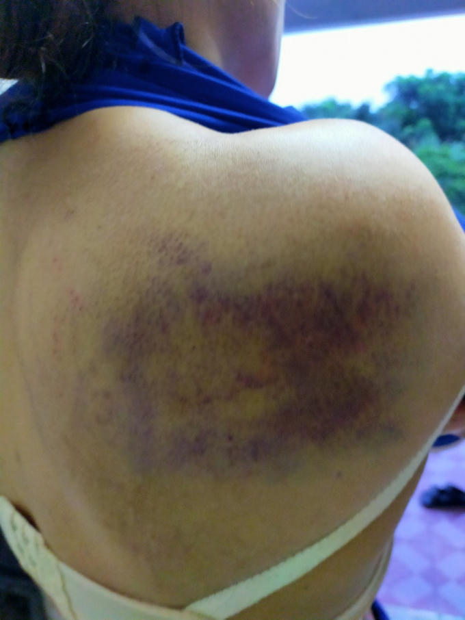 Vùng chấn thương của bà Hường bị người đàn ông dùng cuốc bổ vào người