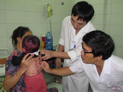 Nhiều trẻ vẫn mắc thủy đậu dù đã chích ngừa vắc-xin 1 lần. Ảnh: Vietnamnet