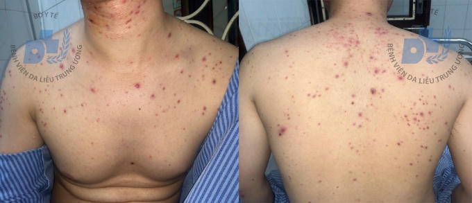 Sau 1,5 tháng sử dụng thuốc nam, bệnh nhân xuất hiện thêm nhiều tổn thương sẩn mụn mủ kích thước đồng đều, rải rác vùng thân mình, cánh tay 2 bên. Ảnh: BV Da liễu TW