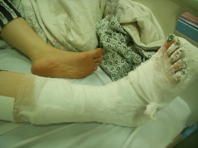 Chân chị Hảo bị các đối tượng dùng tuýp sắt đánh mạnh phải băng bó.