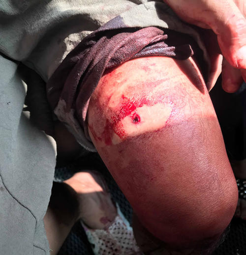 Người nhà nạn nhân cho biết, có 3 khẩu súng đã được nhóm côn đồ mang tới. Vết thương của các nạn nhân được nhận định là do súng hoa cải.