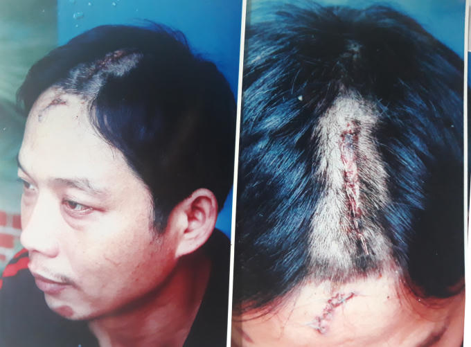 Vết thương anh Vinh bị chém được điều trị tại bệnh viện với tỉ lệ thương tật 12%.
