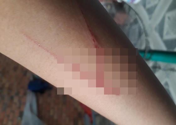 Bé gái thừa nhận vết thương trên tay là do tự dùng vật nhọn rạch