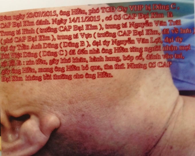 Ông Vũ Xuân Hiền "tố" bị công an đánh.