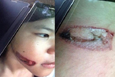 Những vết thương để lại trên cơ thể bé gái.