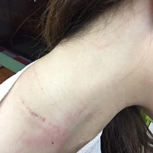 Vết thương trầy xước do bị hành hung trên cổ bà Nguyễn Lê Quỳnh Anh.