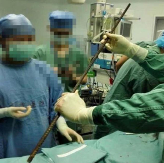 Thanh sắt dài khoảng 1,8m được lấy ra khỏi cơ thể người đàn ông 46 tuổi. (Ảnh: The Sun) 