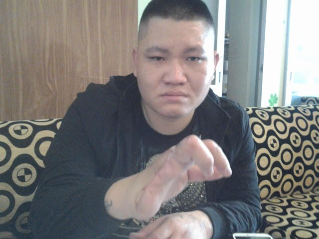 Anh Nguyễn Sơn Tùng với bàn tay bị chém cụt gần 2/3 và đang có biểu hiện hoại tử.