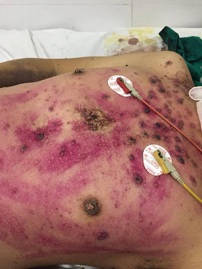 Tự mua thuốc điều trị thủy đậu, nam thanh niên 28 tuổi nguy kịch