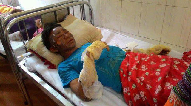 Nạn nhân bị bỏng khí gas đang điều trị tại Bệnh viện đa khoa huyện Bắc Hà.