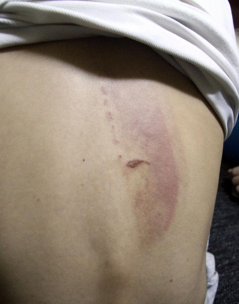 Phía sau lưng của Phong vẫn còn vết bầm tím lớn do gậy vụt trúng. Ảnh Phi Hùng.