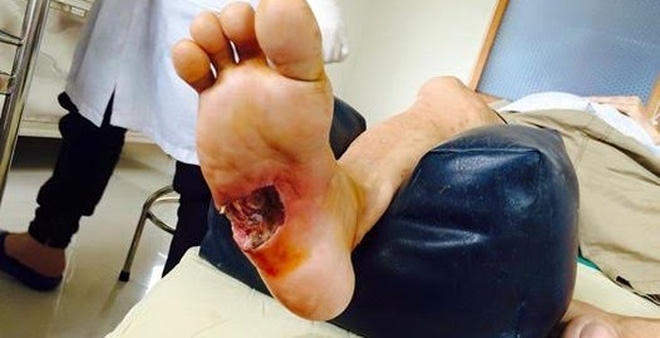 Bàn chân bị hoại tử vì biến chứng tiểu đường.