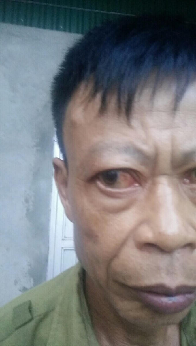 Ông Thụ có nguy cơ hỏng mắt do Hùng đánh.