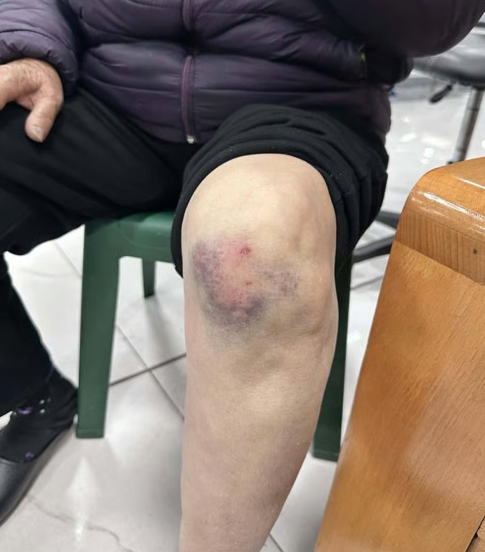 Cụ bà bị xô ngã tím chân.