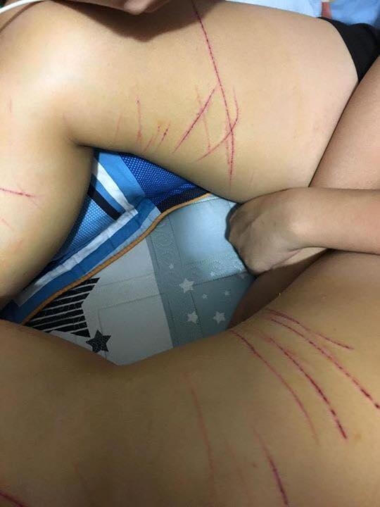 "Kẻ biến thái" dùng dao tem rạch nhiều nhát vào đùi và chân. Ảnh: Facebook Hạnh Vũ.