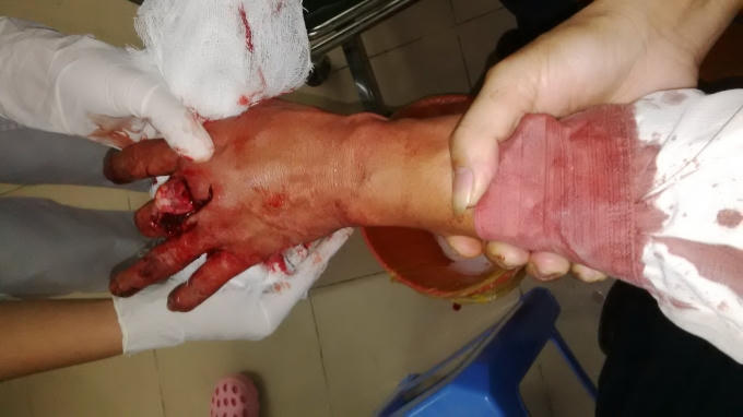 Vết thương của người bị hại Nguyễn Đoàn Bộ do bị can Nguyễn Vinh Tâm gây ra.