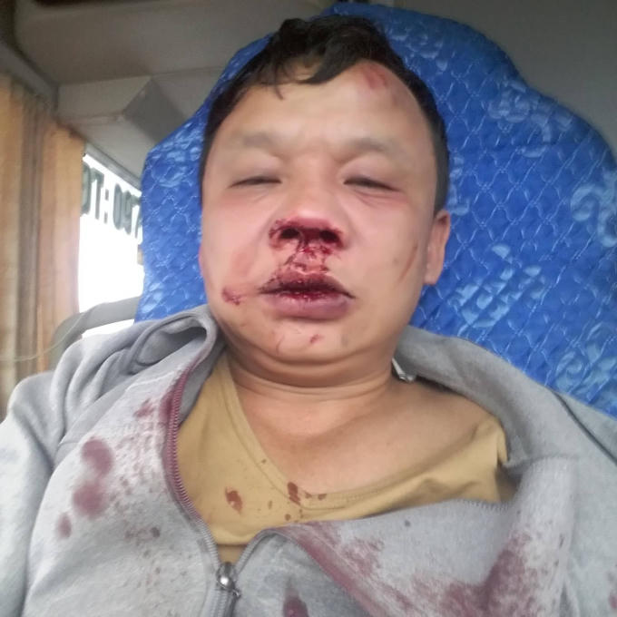 Anh Thiên bị nhóm thanh niên lạ đánh nhập viện trong tình trạng đa chấn thương.