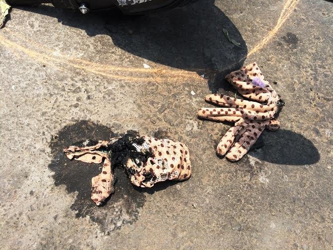 Gang tay của nạn nhân bị cháy do axit.