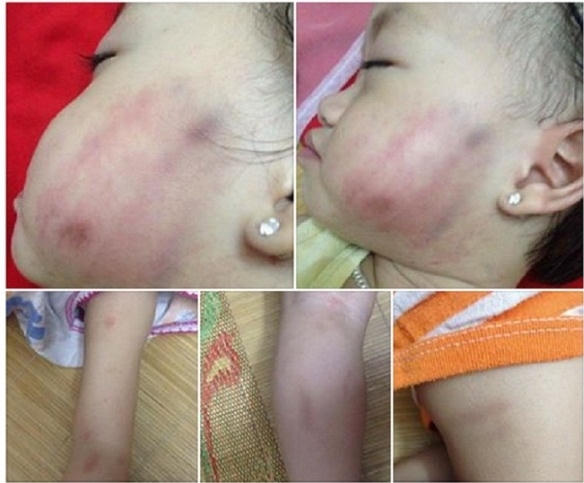 B&eacute; g&aacute;i nghi bị c&ocirc; gi&aacute;o đn&aacute;h t&iacute;m bầm mặt.