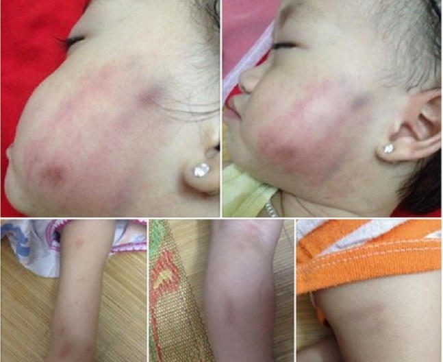 Cháu bé 16 tháng tuổi bị cô giáo đánh bầm tím cơ thể chiều ngày 26/5. (ảnh: FB)