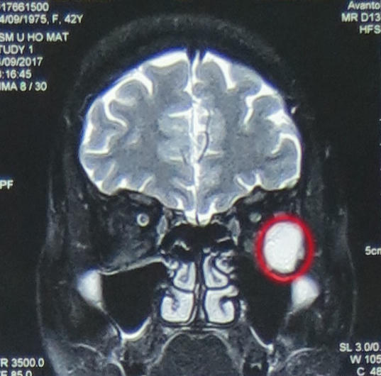 Với chẩn đoán u hốc mắt trái, kích thước 21x17x23mm, chị N.T.M.T đã được mổ nội soi u hốc mắt qua đường mũi. Ảnh: BVCC