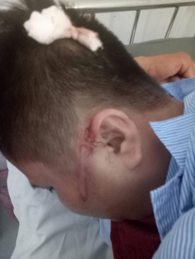 Anh Công bị nhóm người lạ đánh bị thương phần đầu.