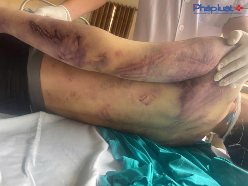 Hình ảnh thương tích của nạn nhân khi được đưa đến Bệnh viện Đa khoa Đông Triều để cấp cứu. Ảnh: Gia đình cung cấp.