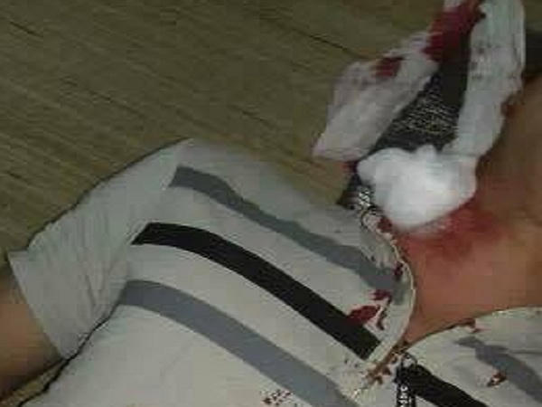 Nạn nhân bị đạn rơi trúng cổ.