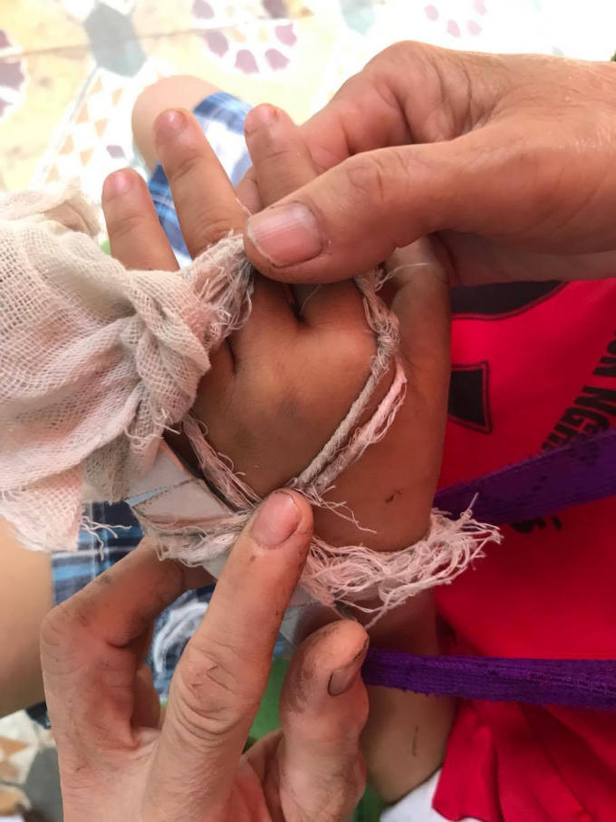 Tay cháu Long bị gãy phải băng bó lại.