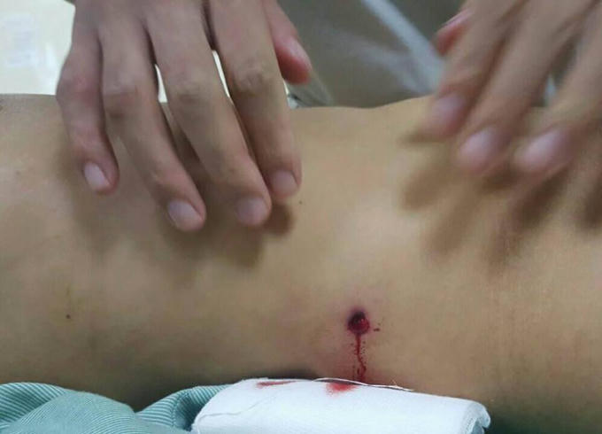 Bệnh nhân bị vết đạn xuyên vào ổ bụng.