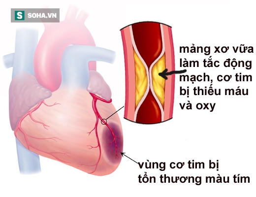 Bệnh nhồi máu cơ tim: Những cái chết không được báo trước