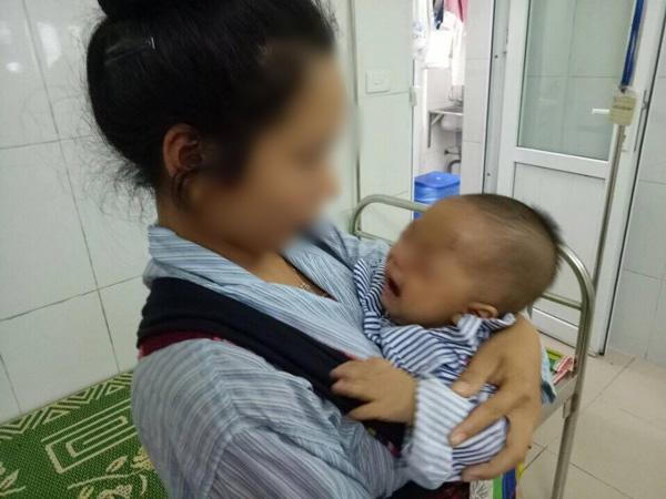Mắt của bé K. biến chứng nặng sau khi mẹ nhỏ sữa mẹ vào