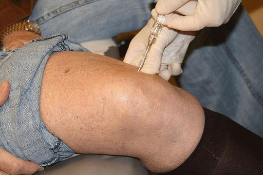 Thói quen tiêm corticoid để giảm đau không theo chỉ định của bác sĩ có thể gây nhiều nguy hiểm