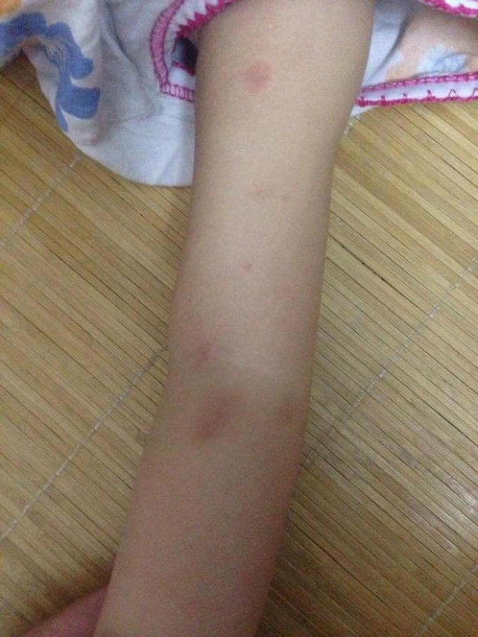 Nhiều người cho rằng, những vết tím trên cánh tay bé là vết cấu, véo.